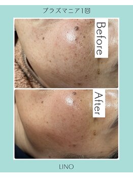 リノ(Lino)/シミケア♪くすみケア♪