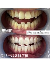 ホワイトニングサロン 京都烏丸店/ホワイトニング施術例