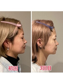 小顔22 ボルティ 本店(Bolty)/30代:小顔シンメトリー(3回)