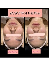 ティアメディカル(Tia Medical)/HIRFWAVEPro