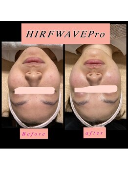 ティアメディカル(Tia Medical)/HIRFWAVEPro