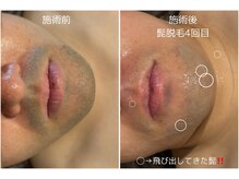 オアシスサカエ(OASIS SAKAE)/【髭脱毛】4回目の施術後★