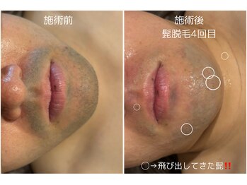 オアシスサカエ(OASIS SAKAE)/【髭脱毛】4回目の施術後★