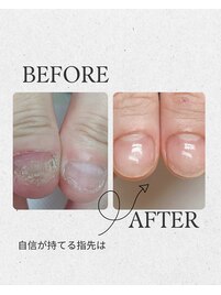 爪噛み　爪育成　スカルプ