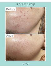 リノ(Lino)/20代のニキビケア♪