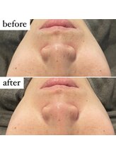 東京デトックス/ハイドロフェイシャルケア