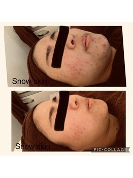 スノースキン(Snow skin)/【ニキビケア＋毛穴ケア激変】
