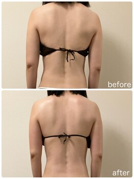 リリィブラン(Lily branc)/痩身/背中+二の腕+ウエスト