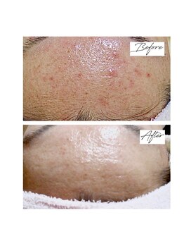 ビズビズ 梅田店(bisebise)/背中ニキビ/ハイドラ毛穴洗浄