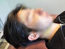 鍼灸院ネクストステップ(鍼灸院NextStep)/男の美容鍼！