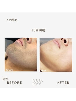 サロン エイトミー(salon 83)/メンズヒゲ脱毛before→after