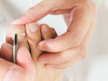 フロー(Froh)の写真/【巻き爪矯正が得意な専門サロン！】爪周囲も徹底的にお手入れするからこそ実現する巻き爪改善♪
