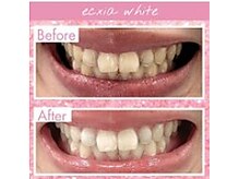 エクシアホワイトニング 中野駅北口店/ホワイトニングビフォーアフター