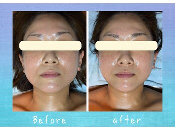 マタハリ(Matahari)/小顔コルギBefore &After