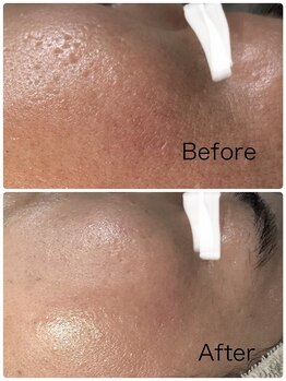 ルミネル 名古屋新栄(Luminelle)/毛穴洗浄