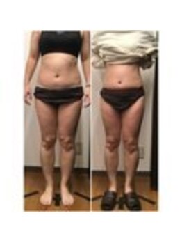 ユメカ 日の出院(YUMEKA)/お腹・脚ラジオ波施術