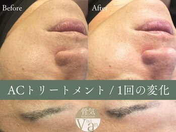 ヴィヴィアン 名駅店(骨気&Relaxation Vivian)/ACトリートメント