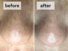 エアル(earu.)/BA|毛穴ケア|ピーリング|高円寺