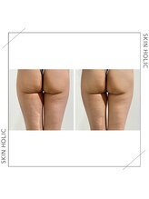 スキンホリック 恵比寿駅前店(SKIN HOLIC)/下半身☆痩身ビフォア＆アフター