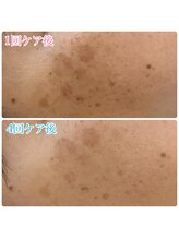 たいち接骨院/シミケア