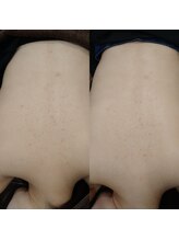 ボーソリューション(Beau-Solution)/【30代　背中肌荒れケア】