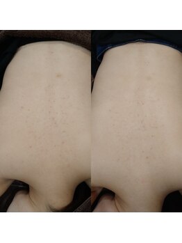 ボーソリューション(Beau-Solution)/【30代　背中肌荒れケア】