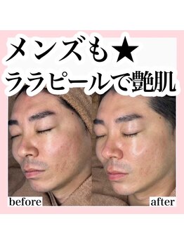 ホリシア 博多(HORISHIA)/ララピール/毛穴/ニキビケア