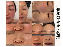 マインエム(mine.m)の雰囲気（長年の赤み乾燥毛穴から透明感艶肌へ）