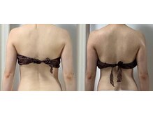 リュミエール(Lumiere)/肩ライン変化