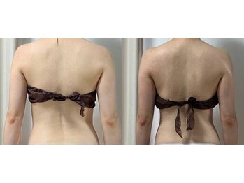 リュミエール(Lumiere)/肩ライン変化