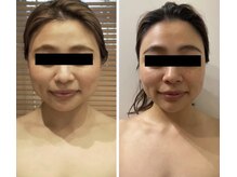 ルナグランデ(Luna grande.)/脂肪撃退で小顔ゲット