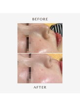 ヒヨリ(hiyori)/《before/after》毛穴洗浄