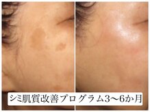 ヌー 栄(nuu)/シミ肌質改善プログラム3～6か月