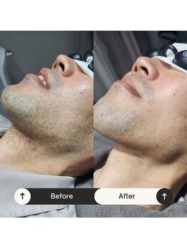 ユーフェム(U-fem)/ヒゲ10回目のお客様