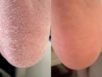 エマネイル(emma nail)の写真/乾燥でガサガサのかかとも頬ずりしたくなるほどつるつるかかと＆足裏に！当店オリジナル極上フットバス付♪