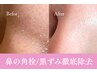 〈いちご鼻徹底除去！！〉ピーリング＋角栓吸引コース