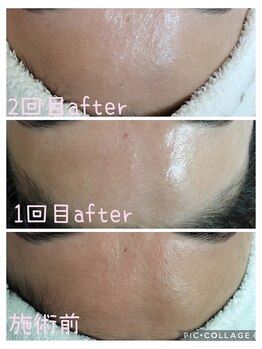 リリーミー(Lily me)/サーマルフラクショナル