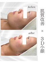 リアム(LiAm)/ララピール×レモンボトル