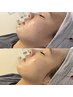 【小顔・脂肪分解】韓国美容"レモンボトル"(DTなし、即効性・持続力◎)