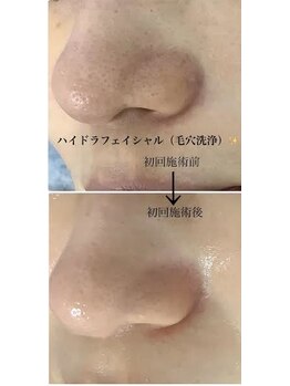 メディカルサロンドオフ 堺東店(medical salon de off)/ハイドラフェイシャル(毛穴洗浄)