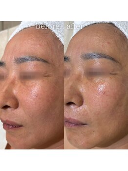 エステティックサロン ナチュラーレ/くすみ・小ジワ・ツヤ感アップ