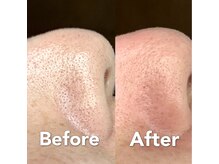 ルルシェリー 白河店の雰囲気（毛穴に付着している酸化した黒ずみ毛穴もきれいになります♪）