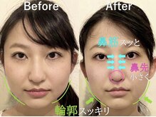 ラプリ 大宮店(Raplit)/隆鼻＋輪郭矯正40分10回