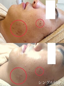 小顔フェイスラボ 鈴鹿店(小顔FaceLabo.)/◆毛穴改善・ニキビケア◆