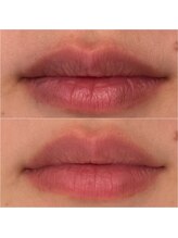 エ リンダ(E- LINDA)/ルメラ