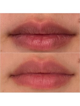 エ リンダ(E- LINDA)/ルメラ