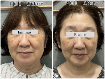 エミマス ボーテ(Emimas Beaute’)/５０代　毛穴洗浄＆幹細胞２回目