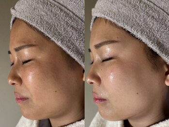 アンティアージュ 福岡本店(antiage)/くすみ悩み解決！