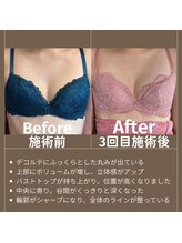 エミニナル(EMININAL)/【バストケア】ビフォーアフター