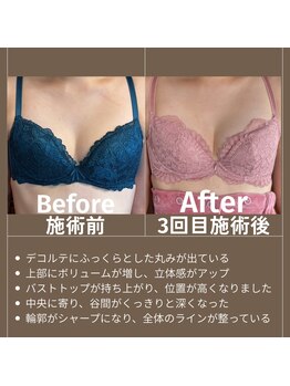 エミニナル(EMININAL)/【バストケア】ビフォーアフター